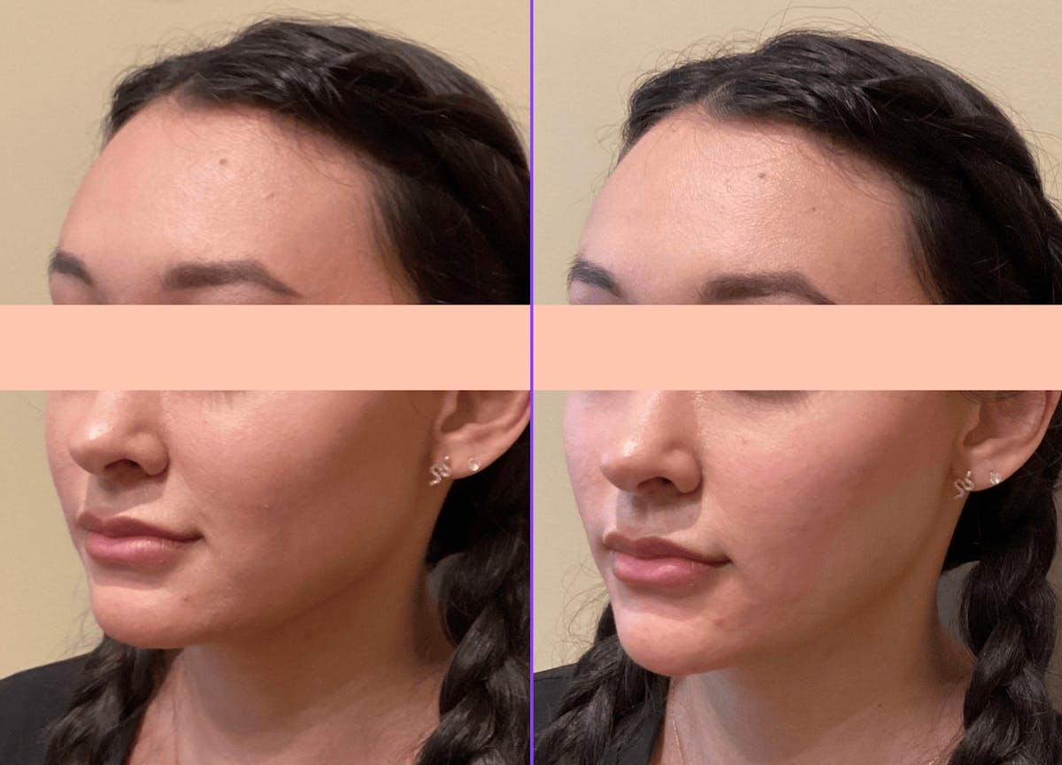 Voluma Before & After Gallery - Patient 313606 - Image 1