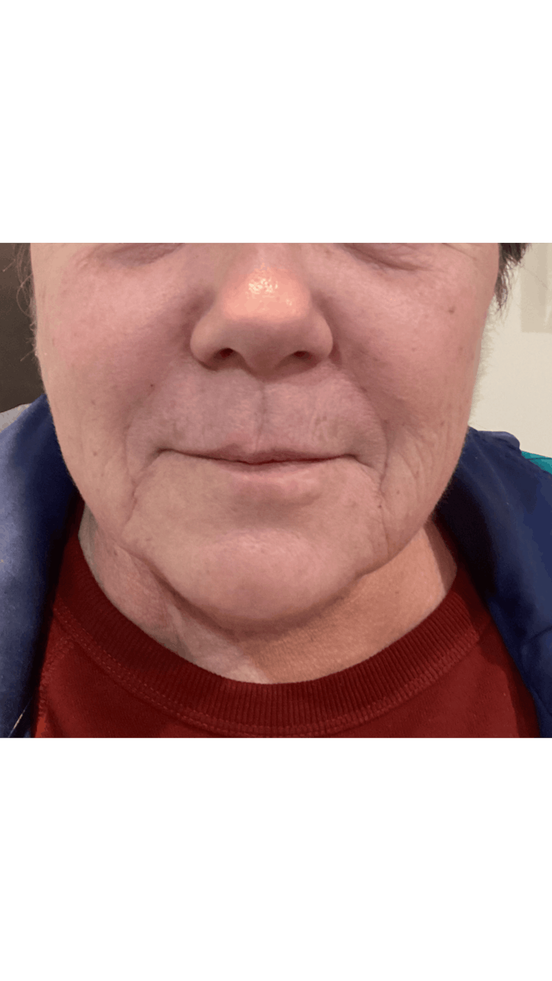 Vollure Before & After Gallery - Patient 635053 - Image 1