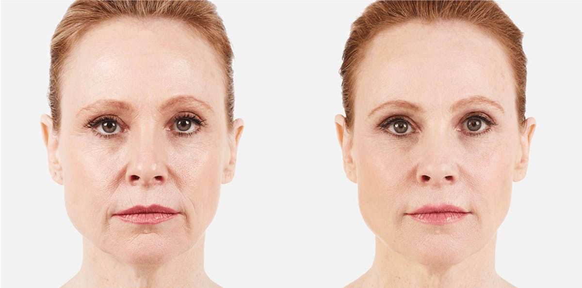 Vollure Before & After Gallery - Patient 177085 - Image 1
