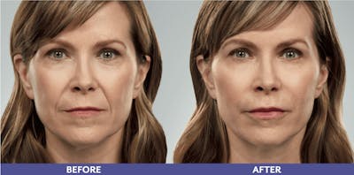 Vollure Before & After Gallery - Patient 304950 - Image 1
