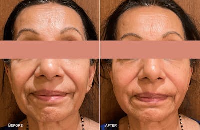 Thread Lift Before & After Gallery - Patient 424854 - Image 1
