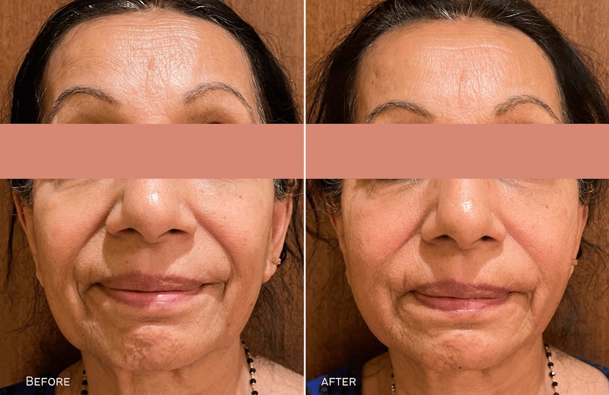 Thread Lift Before & After Gallery - Patient 424854 - Image 1