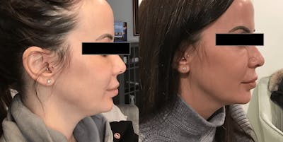 Thread Lift Before & After Gallery - Patient 384619 - Image 1