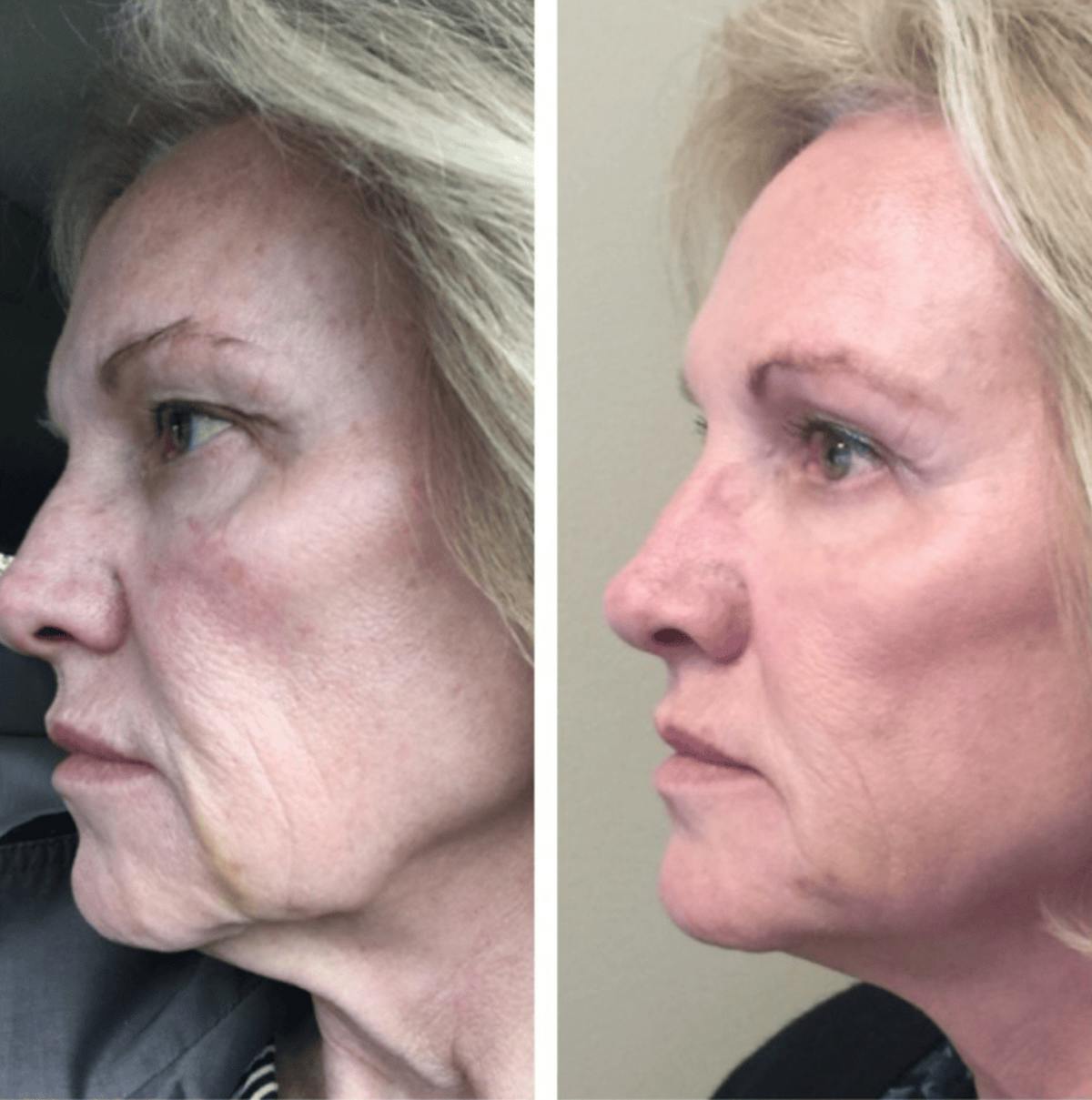 Thread Lift Before & After Gallery - Patient 394135 - Image 1