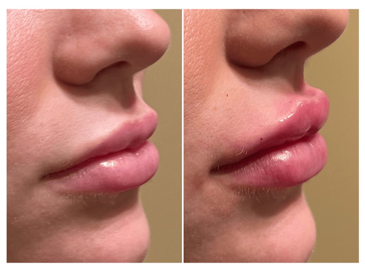 Lips Before & After Gallery - Patient 257370 - Image 1