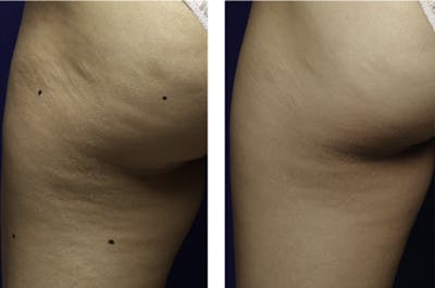 Thermage for Body Before & After Gallery - Patient 936743 - Image 1
