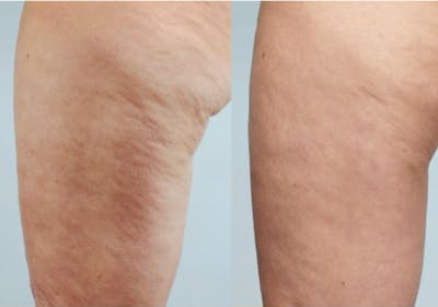 Thermage for Body Before & After Gallery - Patient 178282 - Image 1