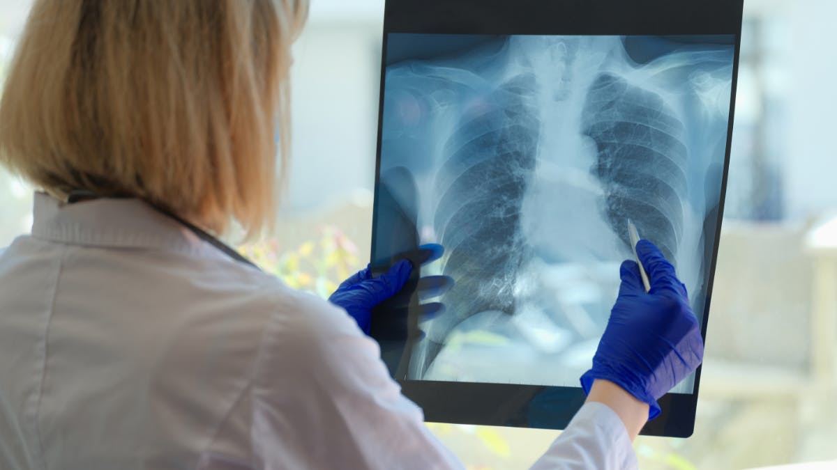 Moving the dial on lung cancer survival: With more screening, comes a greater responsibility to support patients along the way