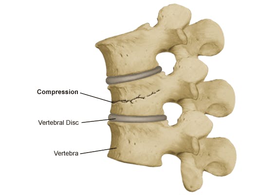 Compression fractures of the back Information