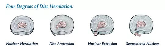 four degrees of disc herniation