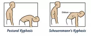 types of kyphosis