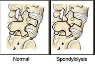 drawn comparison of spine with Spondylolysis