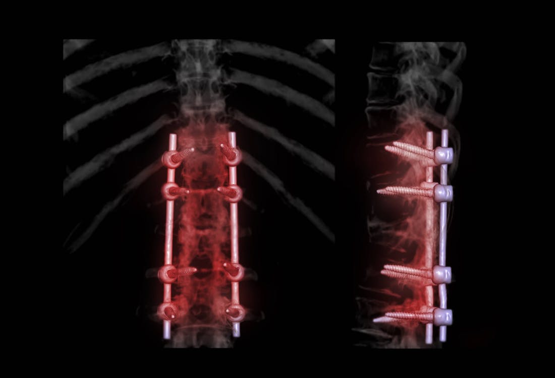 Spine after lumber interbody fusion