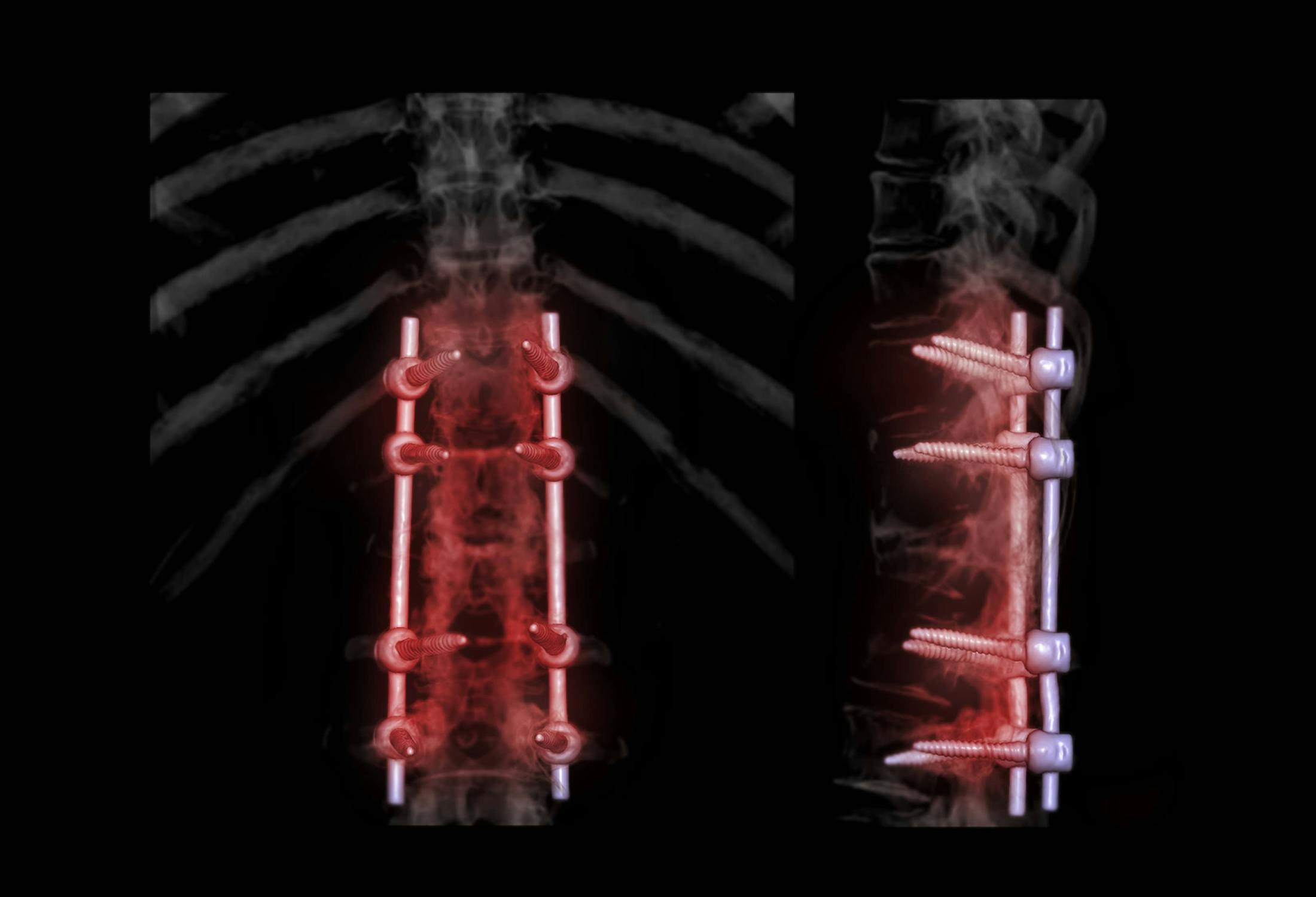 Spine after lumber interbody fusion