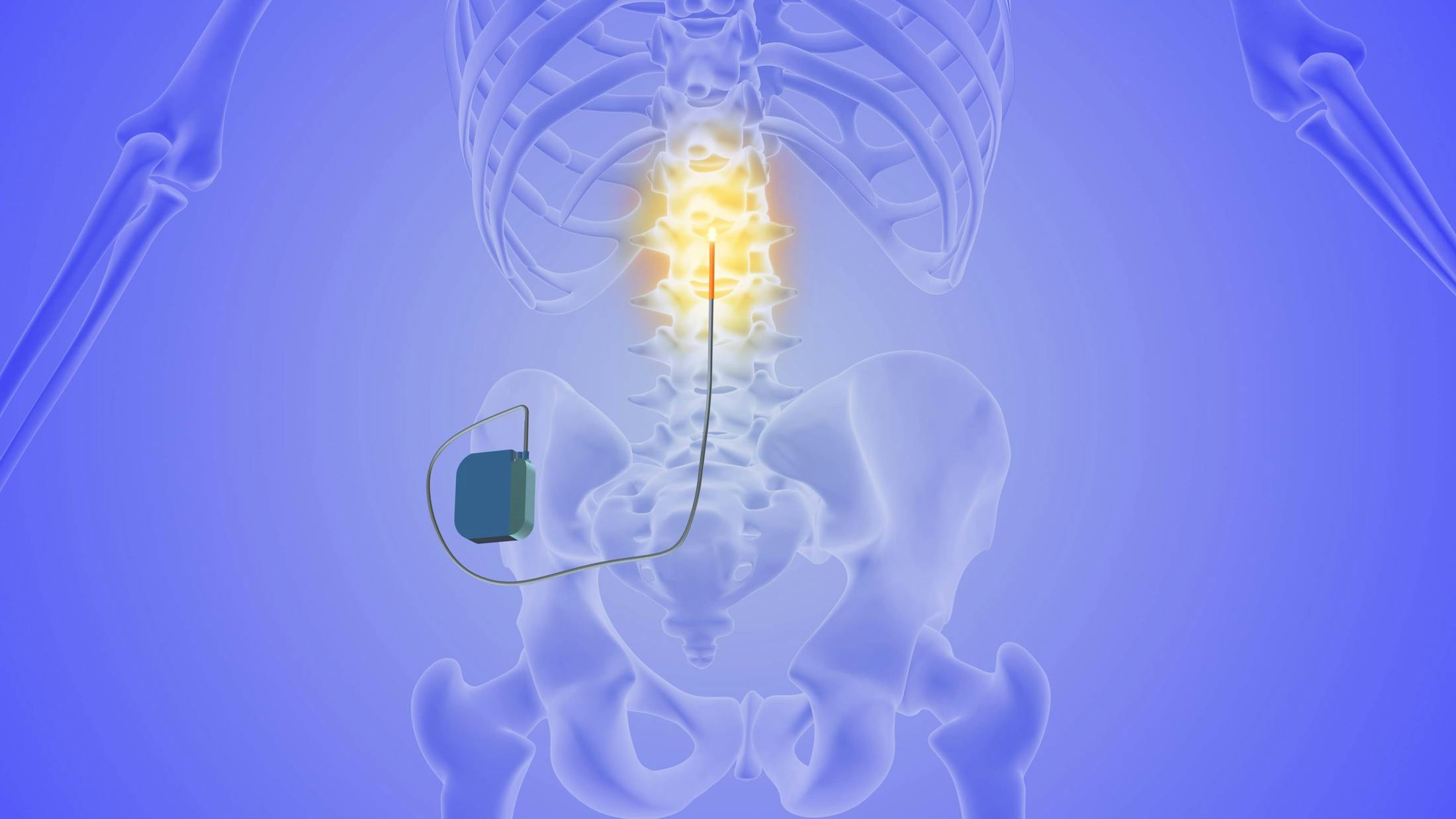 3d image of spinal cord stimulation