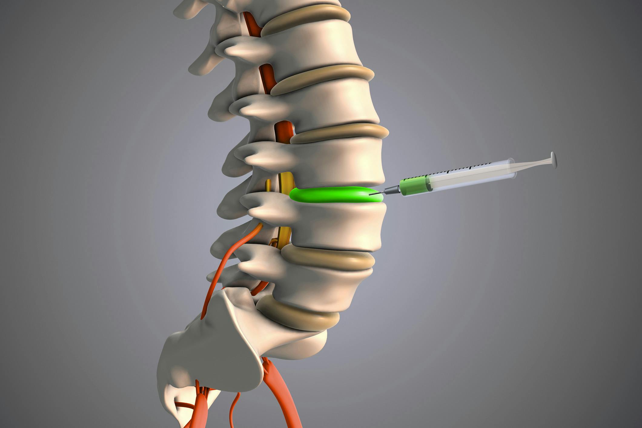 3d image needling injecting fluid into the spine