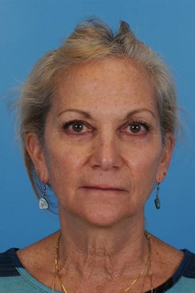 Blepharoplasty Before & After Gallery - Patient 698432 - Image 2