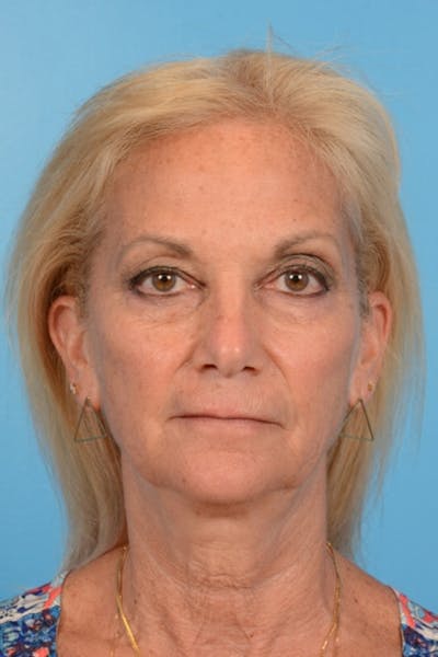 Blepharoplasty Before & After Gallery - Patient 698432 - Image 1