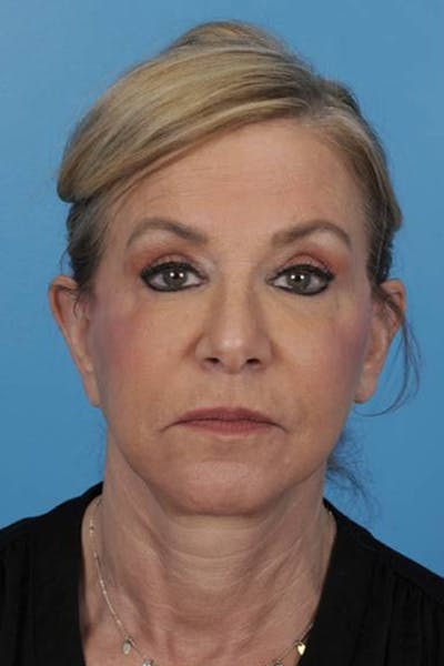 Blepharoplasty Before & After Gallery - Patient 296179 - Image 2