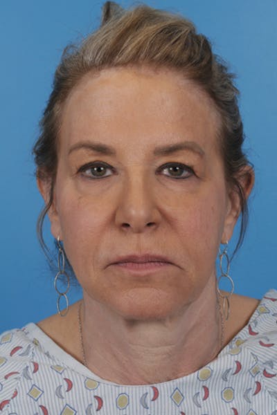 Blepharoplasty Before & After Gallery - Patient 296179 - Image 1