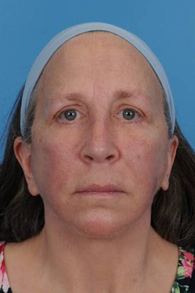Blepharoplasty Before & After Gallery - Patient 193222 - Image 2