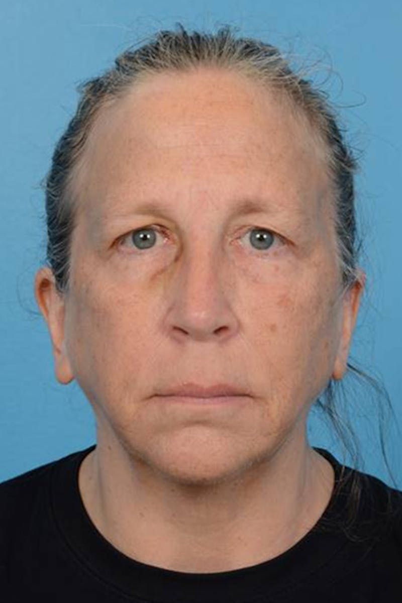 Blepharoplasty Before & After Gallery - Patient 193222 - Image 1
