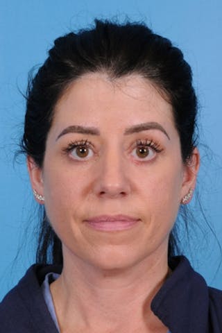 Blepharoplasty Before & After Gallery - Patient 275259 - Image 2