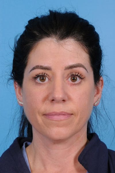 Blepharoplasty Before & After Gallery - Patient 275259 - Image 2