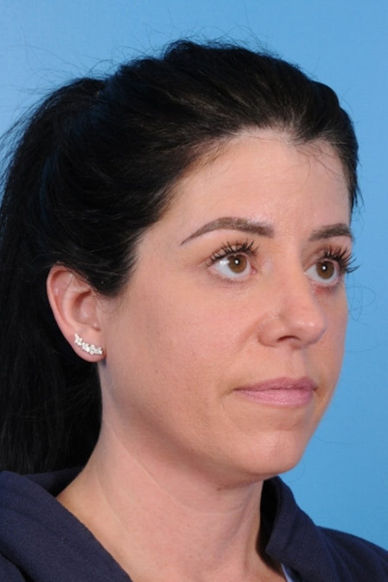 Blepharoplasty Before & After Gallery - Patient 275259 - Image 4
