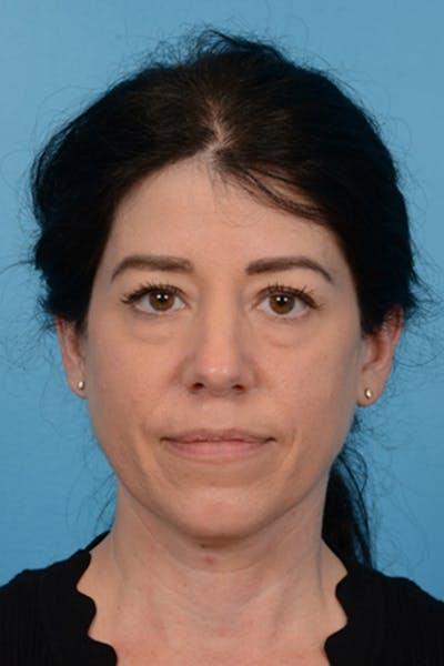 Blepharoplasty Before & After Gallery - Patient 275259 - Image 1
