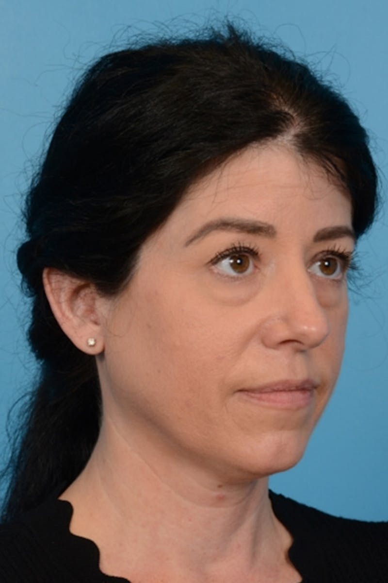 Blepharoplasty Before & After Gallery - Patient 275259 - Image 3