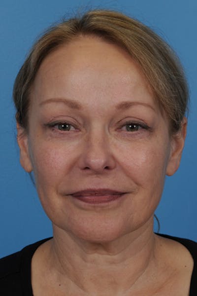 Blepharoplasty Before & After Gallery - Patient 774335 - Image 2