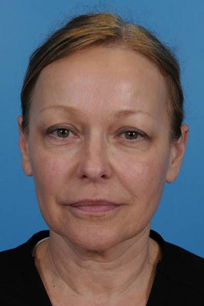 Blepharoplasty Before & After Gallery - Patient 774335 - Image 1