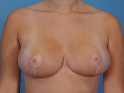 Breast Reduction Before & After Gallery - Patient 266207 - Image 2