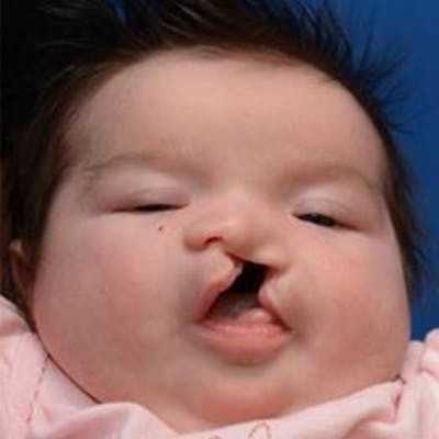 Cleft Lip and Palate Before & After Gallery - Patient 801095 - Image 1