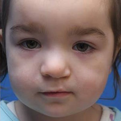 Cleft Lip and Palate Before & After Gallery - Patient 801095 - Image 2