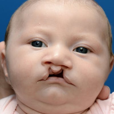 Cleft Lip and Palate Before & After Gallery - Patient 412506 - Image 1