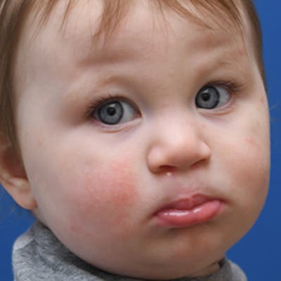 Cleft Lip and Palate Before & After Gallery - Patient 412506 - Image 2
