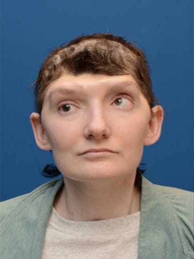 Cranioplasty Before & After Gallery - Patient 372773 - Image 1