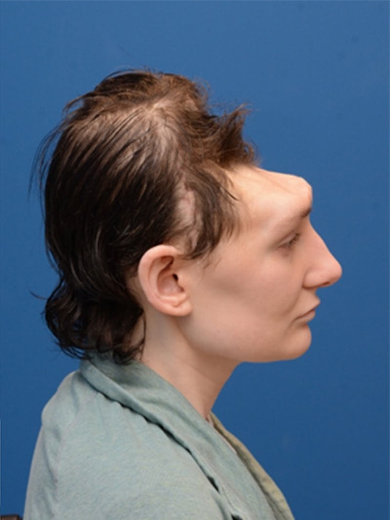 Cranioplasty Before & After Gallery - Patient 372773 - Image 3