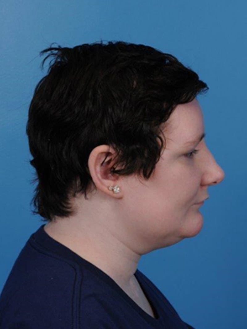 Cranioplasty Before & After Gallery - Patient 372773 - Image 4