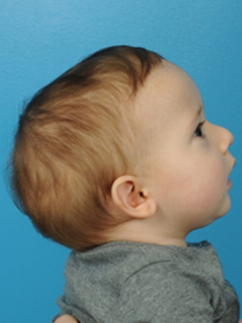 Craniosynostosis Before & After Gallery - Patient 335877 - Image 3