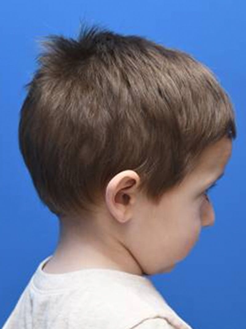 Craniosynostosis Before & After Gallery - Patient 335877 - Image 4