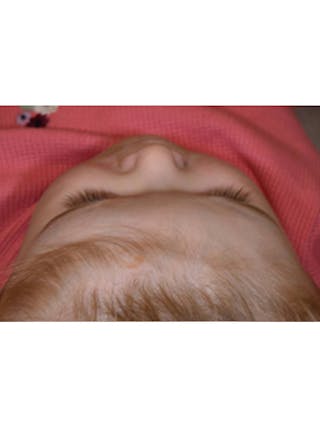 Craniosynostosis Before & After Gallery - Patient 273760 - Image 4