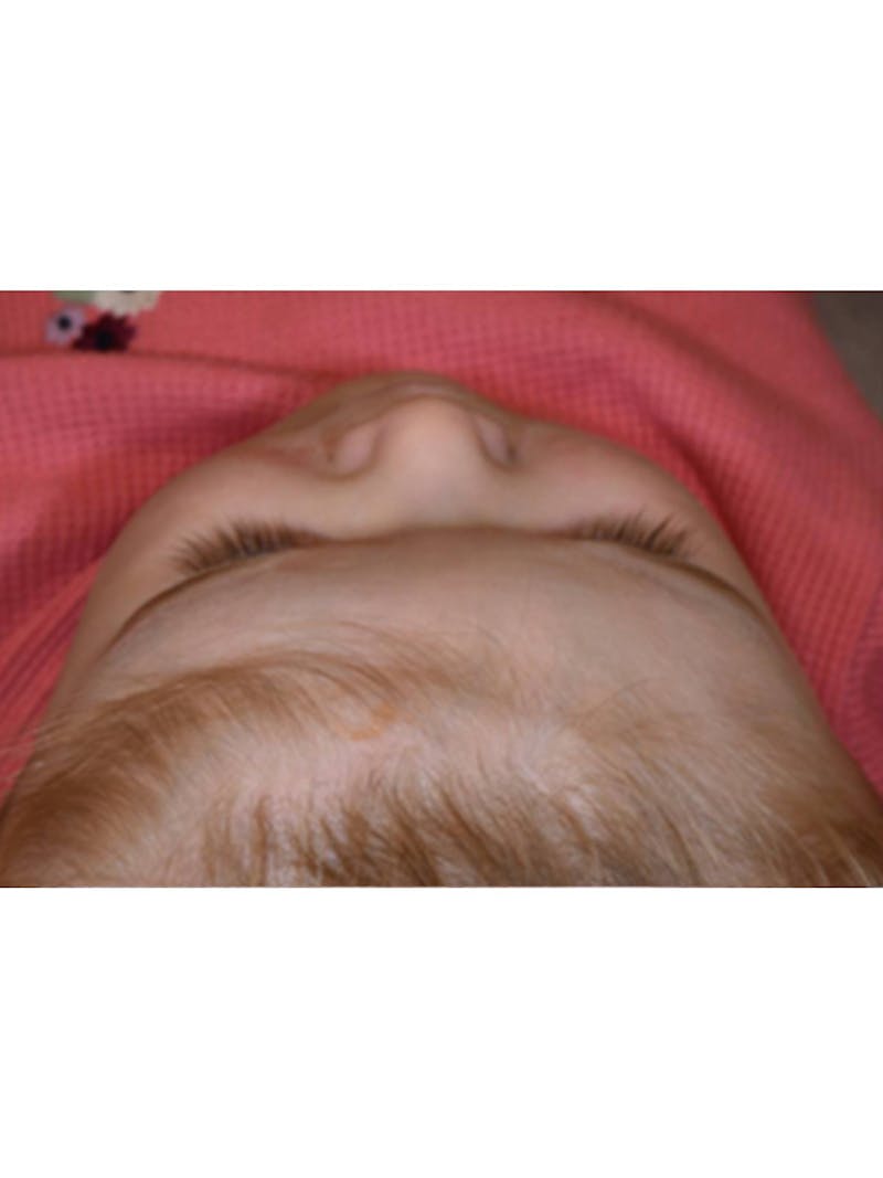 Craniosynostosis Before & After Gallery - Patient 273760 - Image 4