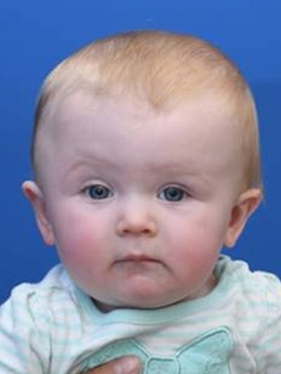 Craniosynostosis Before & After Gallery - Patient 273760 - Image 1