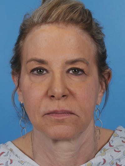 Facelift Before & After Gallery - Patient 180437 - Image 1