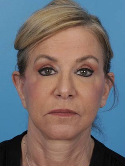 Facelift Before & After Gallery - Patient 180437 - Image 2