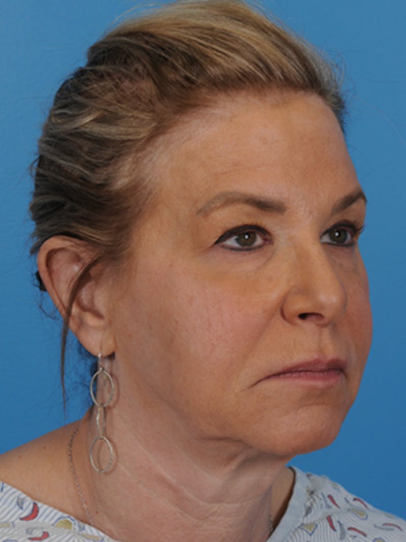 Facelift Before & After Gallery - Patient 180437 - Image 3