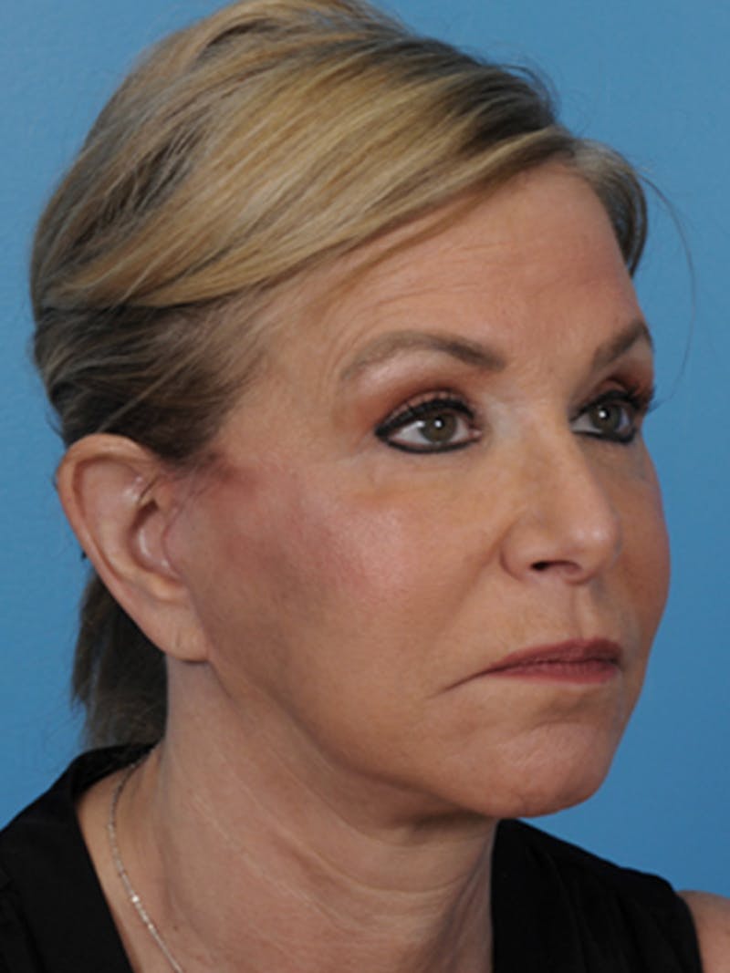Facelift Before & After Gallery - Patient 180437 - Image 4